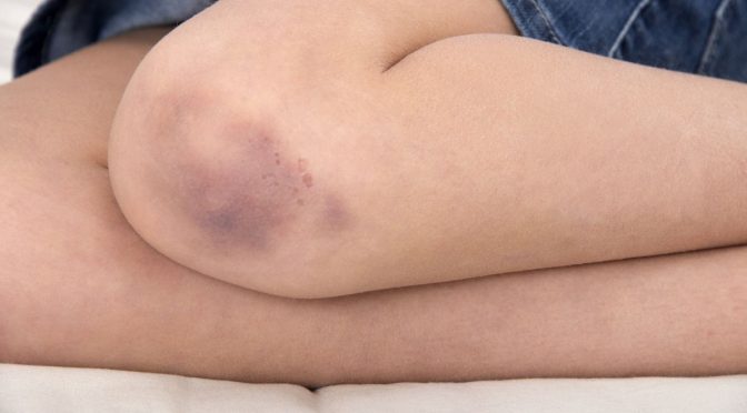 Understanding Random Bruising: 10 Possible Medical Reasons